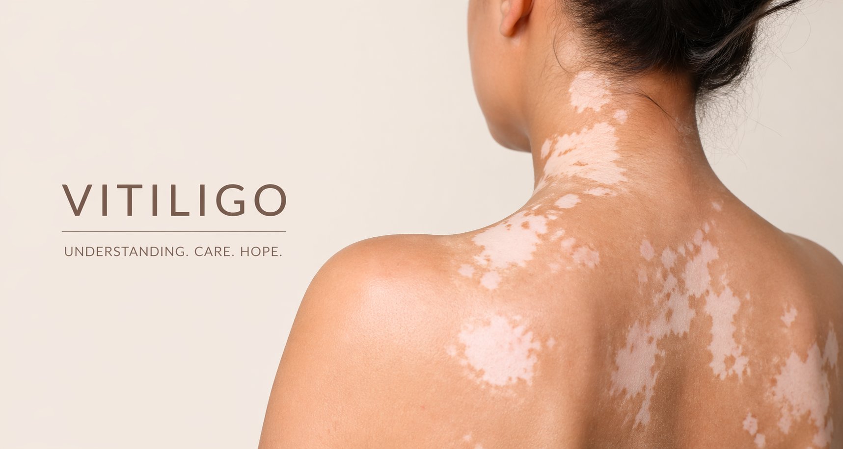 Vitiligo Treatment Programme